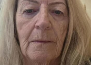 I jetted to the facelift capital at 73 & now look 20 years younger