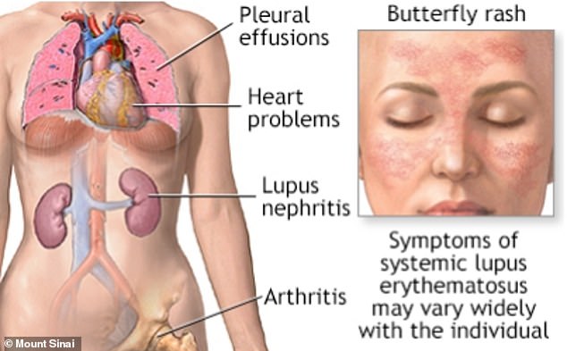 Patients typically begin experiencing symptoms of lupus in their teens or early 20s, though the condition can also develop in childhood or later adulthood