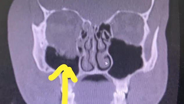 This image shows Kirill's fractured eye socket