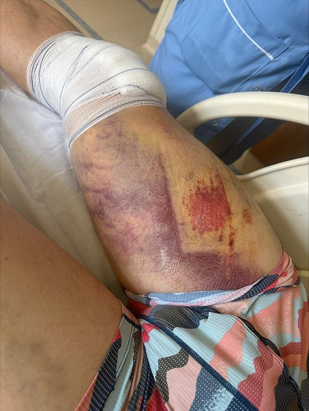 Despite the near-fatal crash, Blukher insists he won't give up the sport that almost killed him. 'Of course I'll keep jumping,' he said. Pictured: Kirill's injured leg