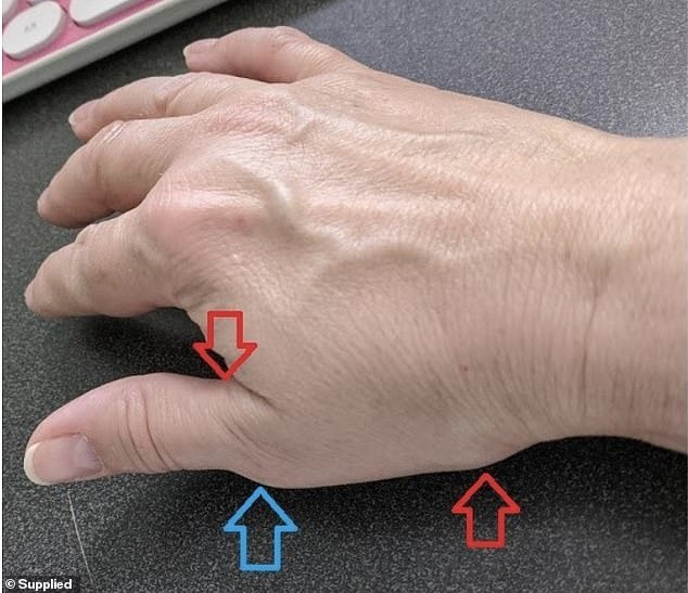 Kat tried everything recommended but nothing helped her swollen and painful hand