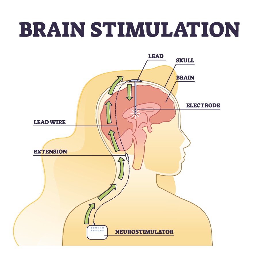 Illustration of a deep brain stimulation procedure with a lead, electrode, lead wire, extension, and neurostimulator in a human outline.
