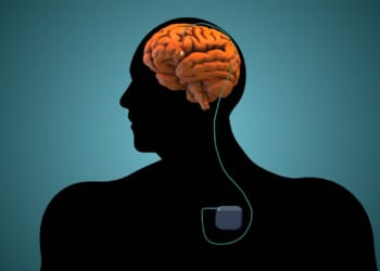 Brain 'pacemaker' treats severe depression and anxiety in HALF of patients by correcting 'bad brain signals'