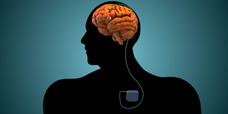 Brain 'pacemaker' treats severe depression and anxiety in HALF of patients by correcting 'bad brain signals'