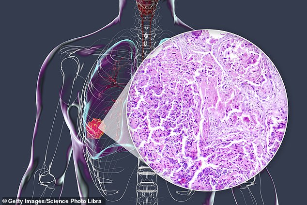 The inventors said this new form could be used to treat many different types of cancer, from brain tumors like gliomas and medulloblastomas to breast, colon, lung (PICTURED), pancreatic and thyroid cancers, and possibly even help prevent cancer in people at high risk
