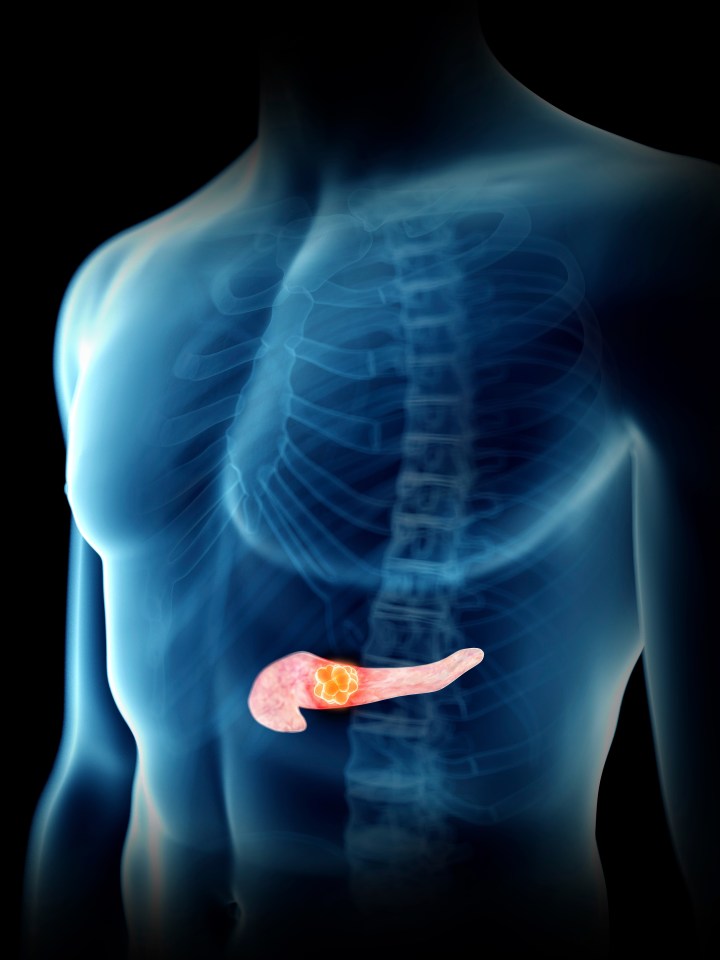 Illustration of a man's pancreas with a tumor.