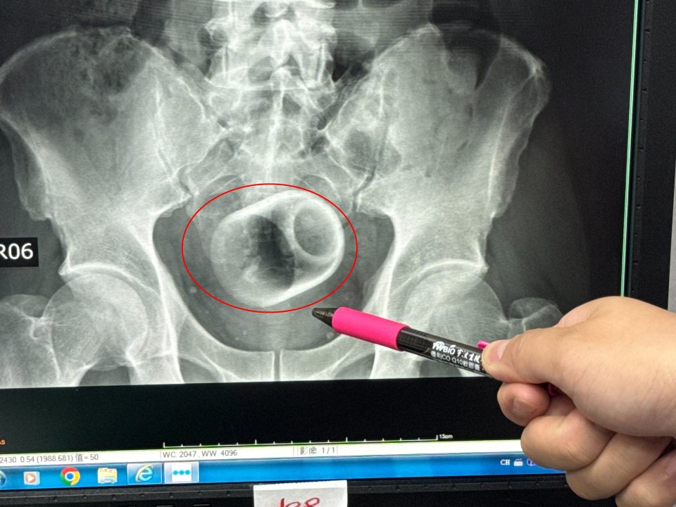 Brew dunnit! Teacup found lodged in constipated man¿s bum leaves doctors stunned