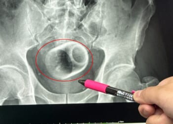 Teacup found in man's bottom after he went to hospital complaining of constipation