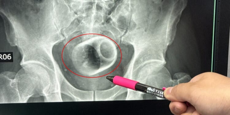 Teacup found in man's bottom after he went to hospital complaining of constipation
