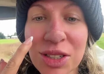 My dog of 11 years ripped the tip of my nose off without any warning