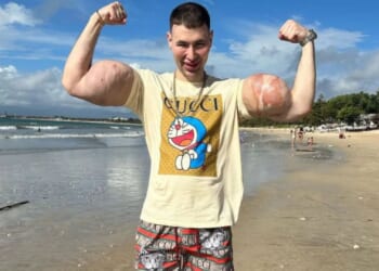 Idiot influencer dubbed Russian Popeye faces losing BOTH arms after pumping them with grim cocktail to give huge biceps