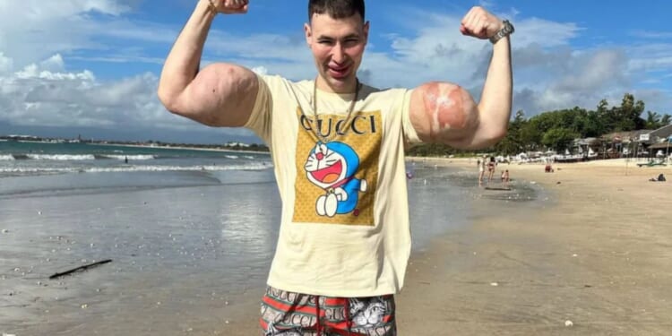 Idiot influencer dubbed Russian Popeye faces losing BOTH arms after pumping them with grim cocktail to give huge biceps