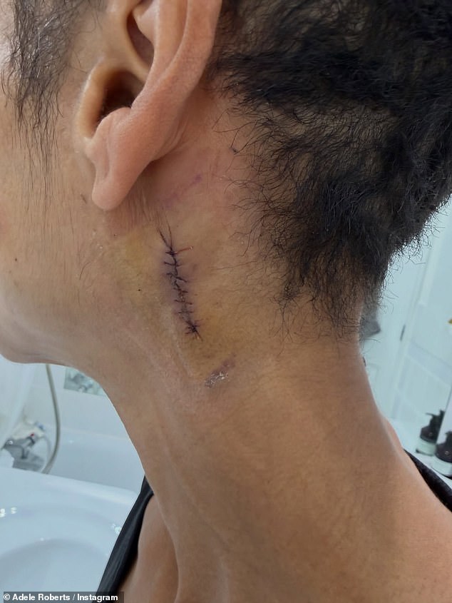 Adele revealed she has been waiting since the end of August for the removal of the lump and has been trying her best in the 'worrying time' to remain positive