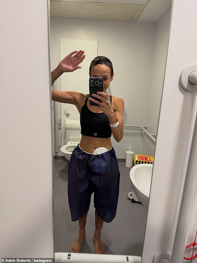 Adele was diagnosed with bowel cancer in October 2021 and documented her treatment on social media, which included colostomy surgery and having a stoma bag fitted