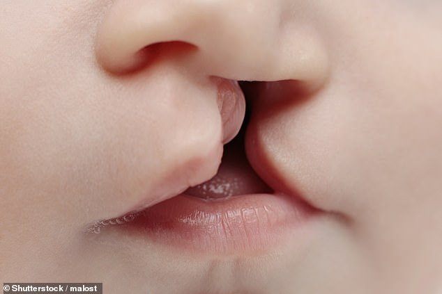 A cleft lip or palate occurs when the parts of a baby's face do not join properly during its development in the womb, leaving a space in the roof of their mouth, lip or both (stock photo)