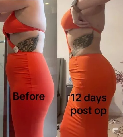 A split image showing a person's side profile before and 12 days after an operation, with text "Before" on the left and "12 days post op" on the right, displaying a changed body shape.