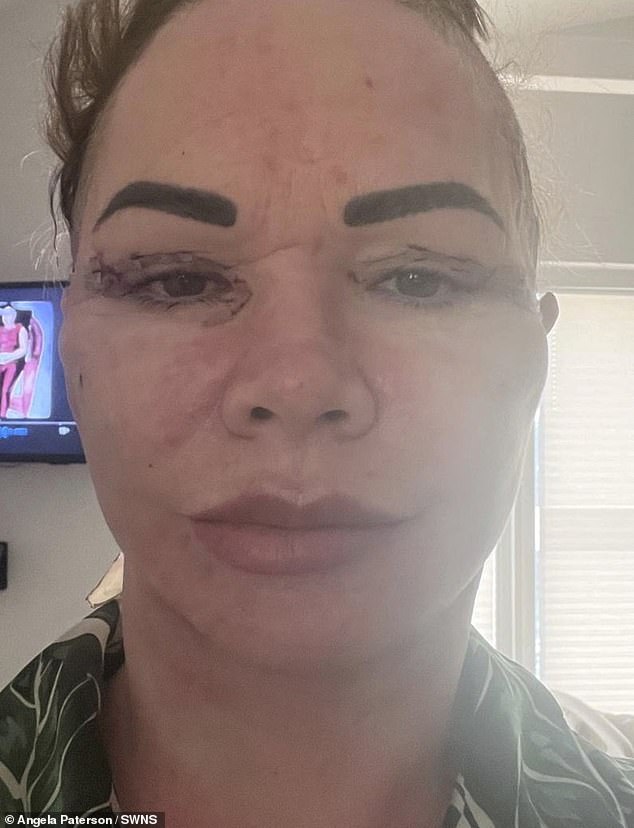 Having seen positive reviews of the clinic and undergone successful surgery in Turkey before, she believed she was in good hands