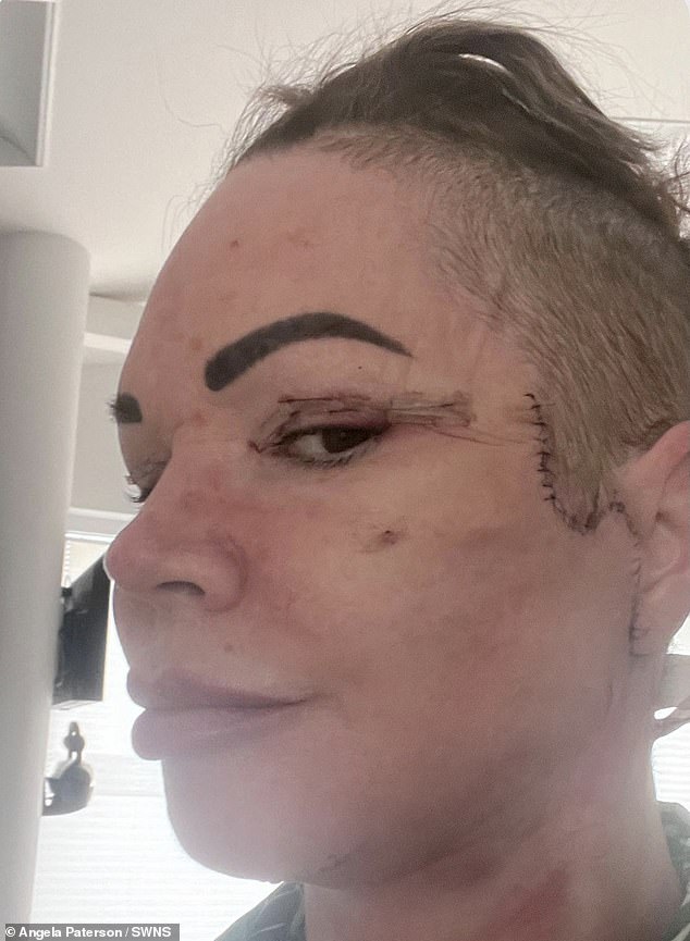 She is set to fly to Turkey for revision surgery to fix her neck and eye next month - and says it will cost over £7,000 for the operation and travel costs.