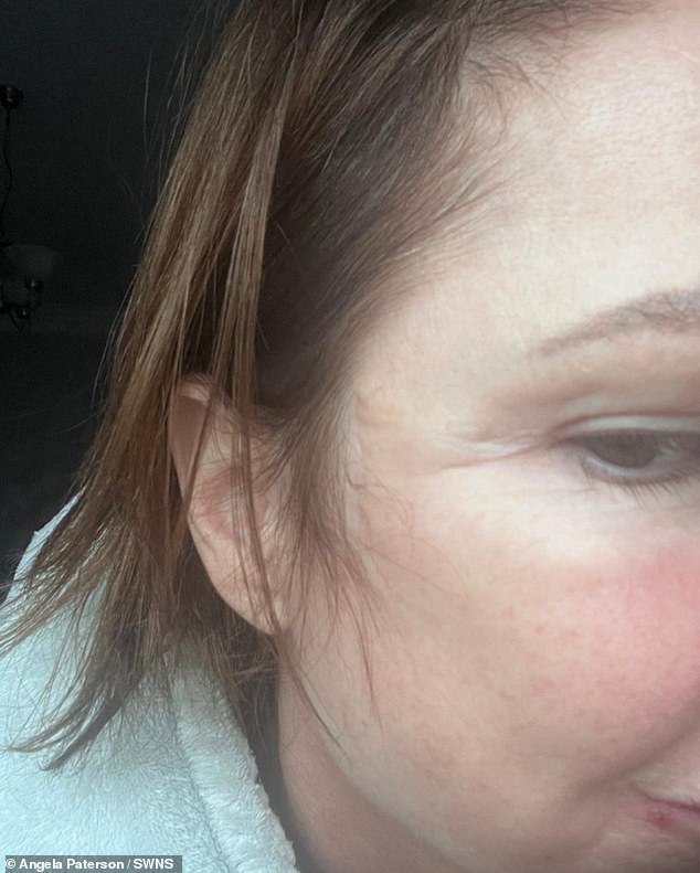She also raised the alarm over scarring around her neck, a bunched-up eye she says was caused by tight stiches, lasting hearing loss in one ear and visible platysma bands