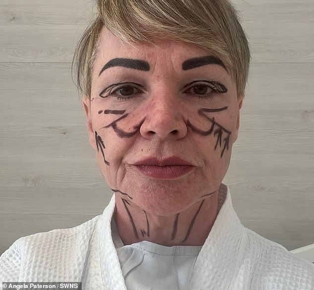 In five weeks' time, she will travel to Turkey to repair her platysma bands, get a temporal lift on her eye and 'level out' of the scarring and lumps on her neck