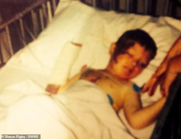 Mr Rigby is pictured in a hospital bed at the time he lost his leg aged two. He has now lost his disability benefits