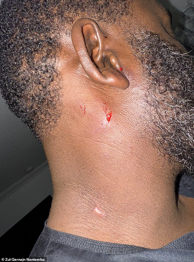 Zül-Qarna¿n Nantambu, who goes by '@fff_zulqarnain' on Instagram, shared photos of his injuries with Daily Mail. Nantambu says a bullet grazed his neck and he broke a finger