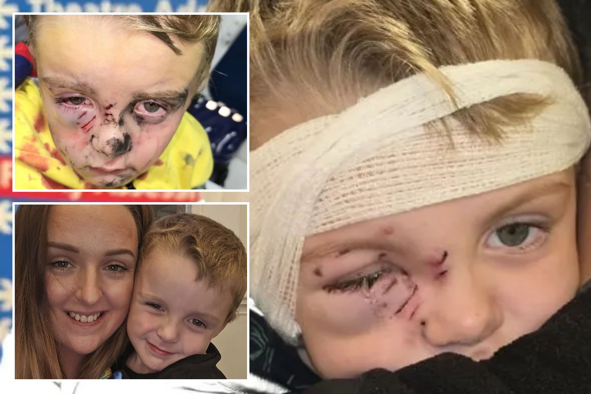 An image collage containing 3 images, Image 1 shows Roman's injuries after the dog attack, showing his bandaged head and injuries to his eye, ears and cheeks, Image 2 shows Mum feared son, 5, was dead when a dog viscously attacked him during school run, Image 3 shows Mum feared son, 5, was dead when a dog viscously attacked him during school run