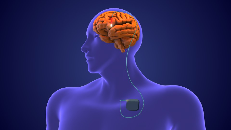 Deep brain stimulation medical concept