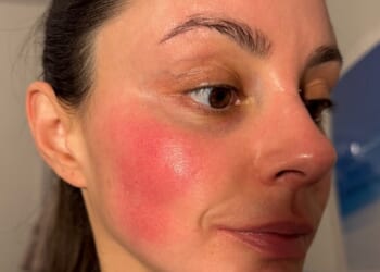Emma shows off a patch of rosacea on her cheek before the treatment