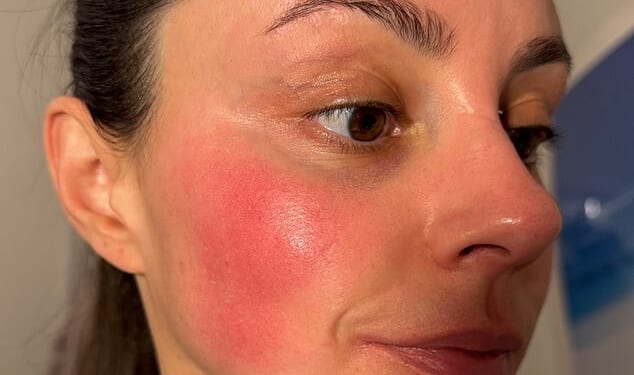 Emma shows off a patch of rosacea on her cheek before the treatment