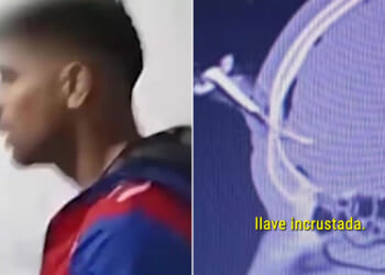 Footballer rushed to hospital after being left with car key lodged in his head following brutal attack