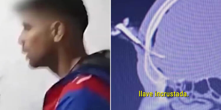 Footballer rushed to hospital after being left with car key lodged in his head following brutal attack