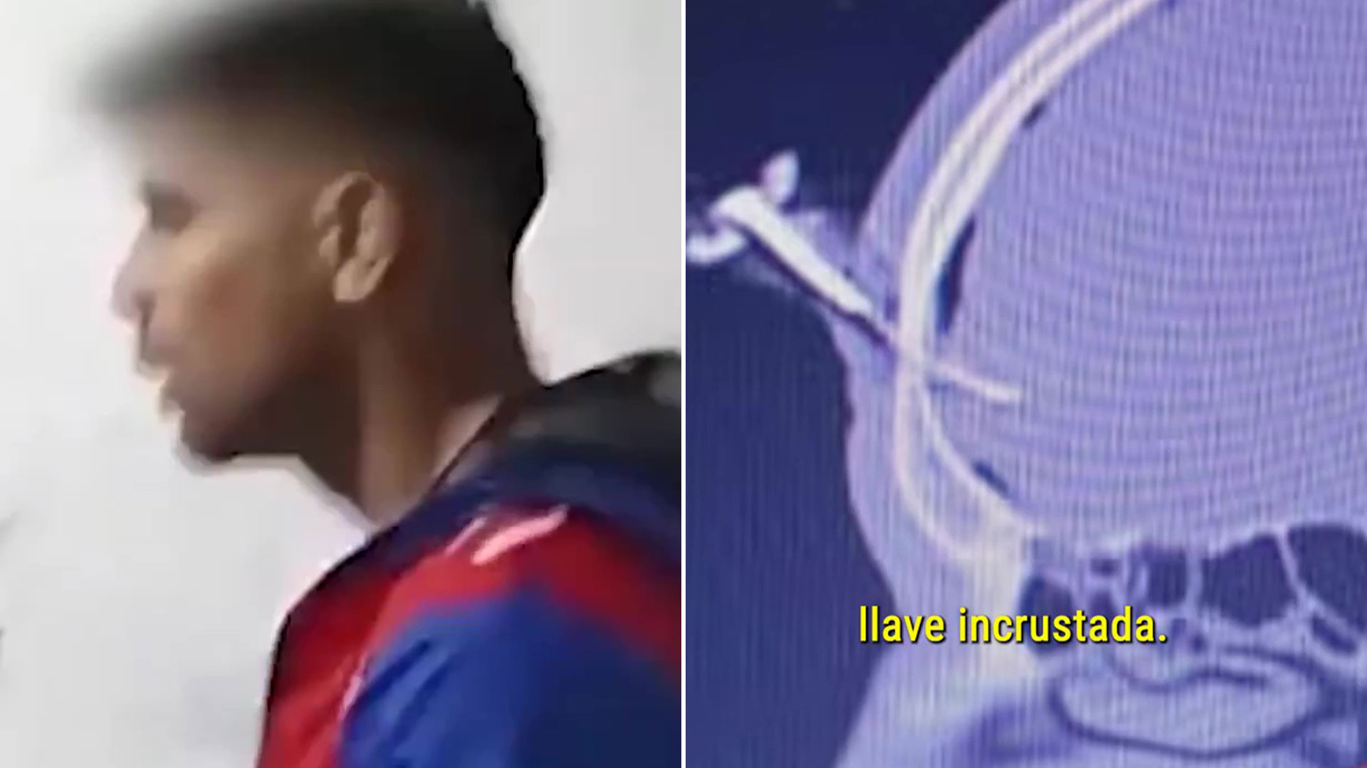 Footballer rushed to hospital after being left with car key lodged in his head following brutal attack