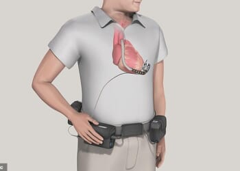 The device, which can be offered to patients who may be waiting for a transplant or are ineligible for one, helps the heart pump around the body. The NHS raised concerns about the device in 2018, with half who were fitted with the product dying within three years