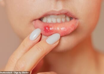 Mouth ulcers are breaks in the lining of the mouth, on the inner lips, inner cheeks or the tongue