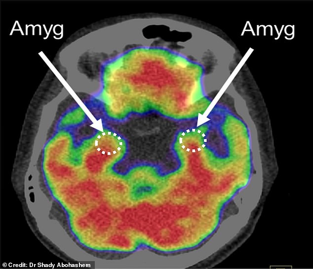 An example of one of the specialised PET/CT imaging scans of the brain in the study