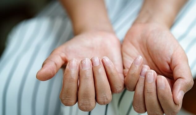 This is what your brittle, yellow or peeling nails really mean for your health - and the tell-tale sign something sinister is going on, revealed by our top expert