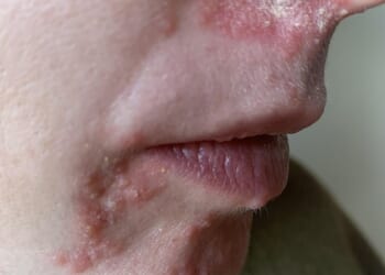 My skin two weeks on from when the condition started... I'd seen no progress