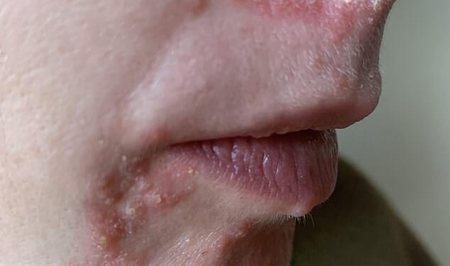 My skin two weeks on from when the condition started... I'd seen no progress