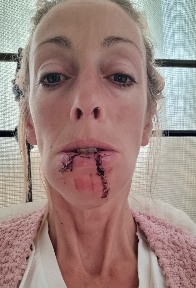 Lauren Chandler with stitches and open wounds on her chin and lower lip.