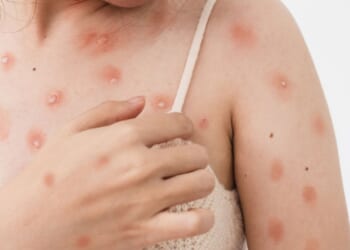 Mutant strain of mpox lands in UK in 'most-feared outcome' as officials issue urgent warning