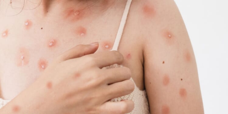 Mutant strain of mpox lands in UK in 'most-feared outcome' as officials issue urgent warning