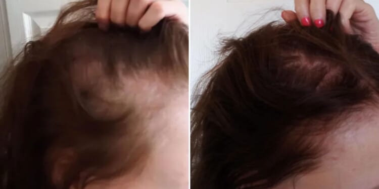 I was struggling with severe hair loss & was going bald