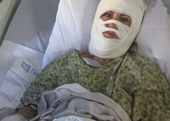 Woman, 46, left with horrific burns after stranger pours acid over her head while walking in park as cops hunt attacker