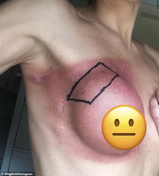 Whigfield battled breast cancer over a decade ago and previously posted a snap of her inflamed right breast online and added she was lucky to have left the hospital