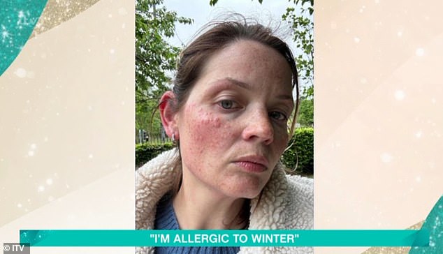 Dr Zoe said of her condition: 'So it's called Urticaria. Urticaria is askin's reaction to the body releasing histimine. Most of us will be familiar withthe nettle sting. Touch a nettle and you get an urticarial reaction, that stinging, urning. We would all have an urticarial reaction to nettles'