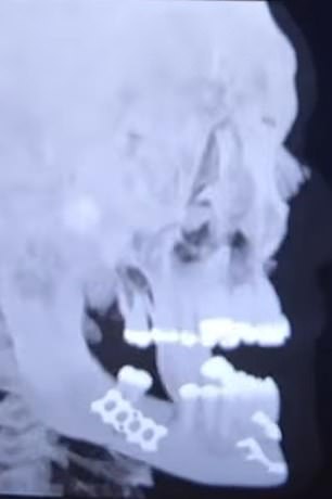 The fighter shared a revealing X-ray with his followers