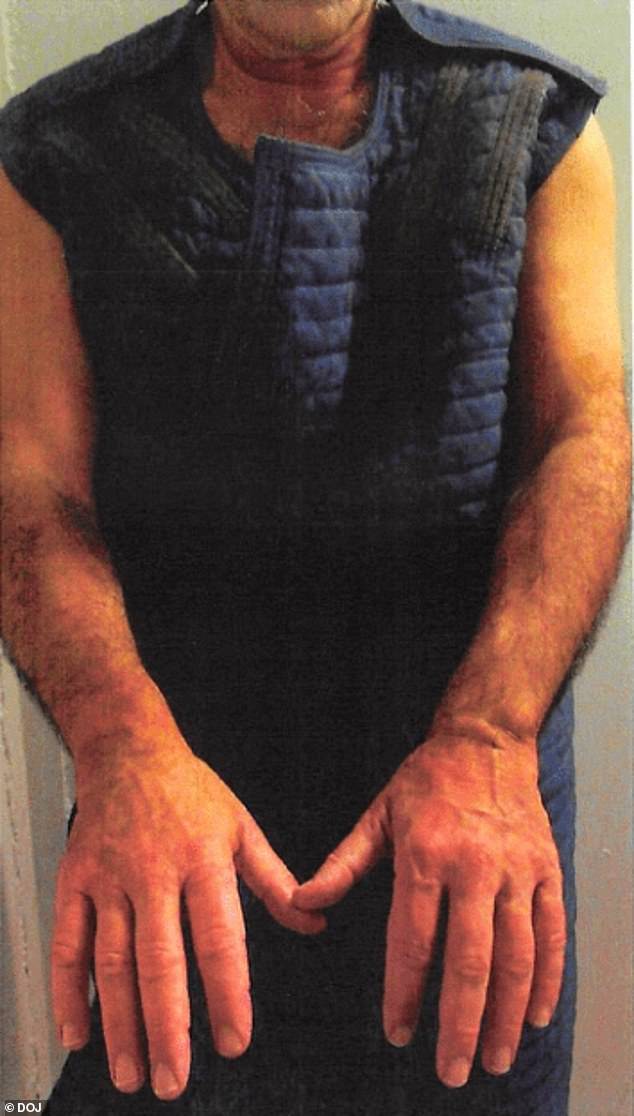 The above image shows Epstein's arms and hands, which appear to be red and swollen after what police believe was a suicide attempt in his cell in January 2019