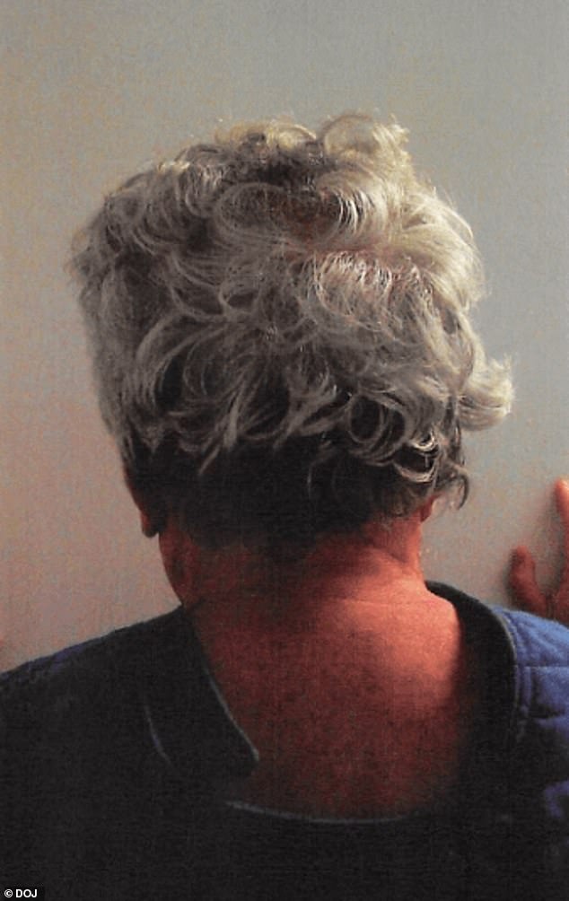 Epstein's neck and the back of his head after what police believe was a suicide attempt