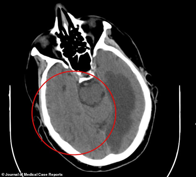 The above CT scan image shows damage to the man's brain tissue, likely due to a stroke. A healthy brain would have distinct gray and white brain tissues, but in this case, the tissue gray and white colors have blended together, signaling a potential lack of oxygen